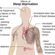 Efectos principales de la privación del sueño. Wikimedia Commons
